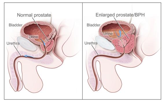 ProstateCancer_2